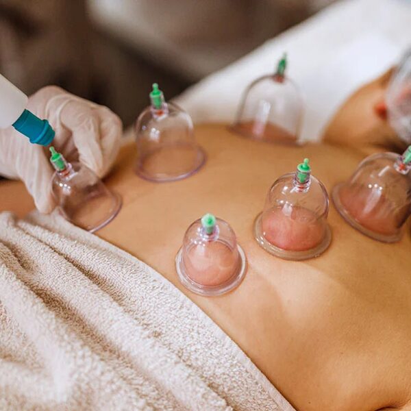 Cupping Therapy