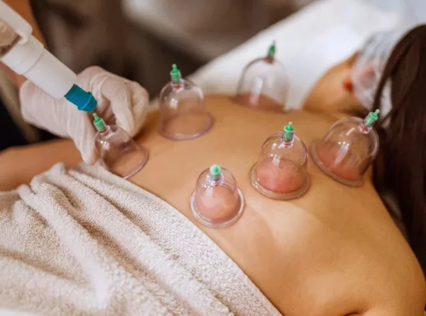 Cupping Therapy